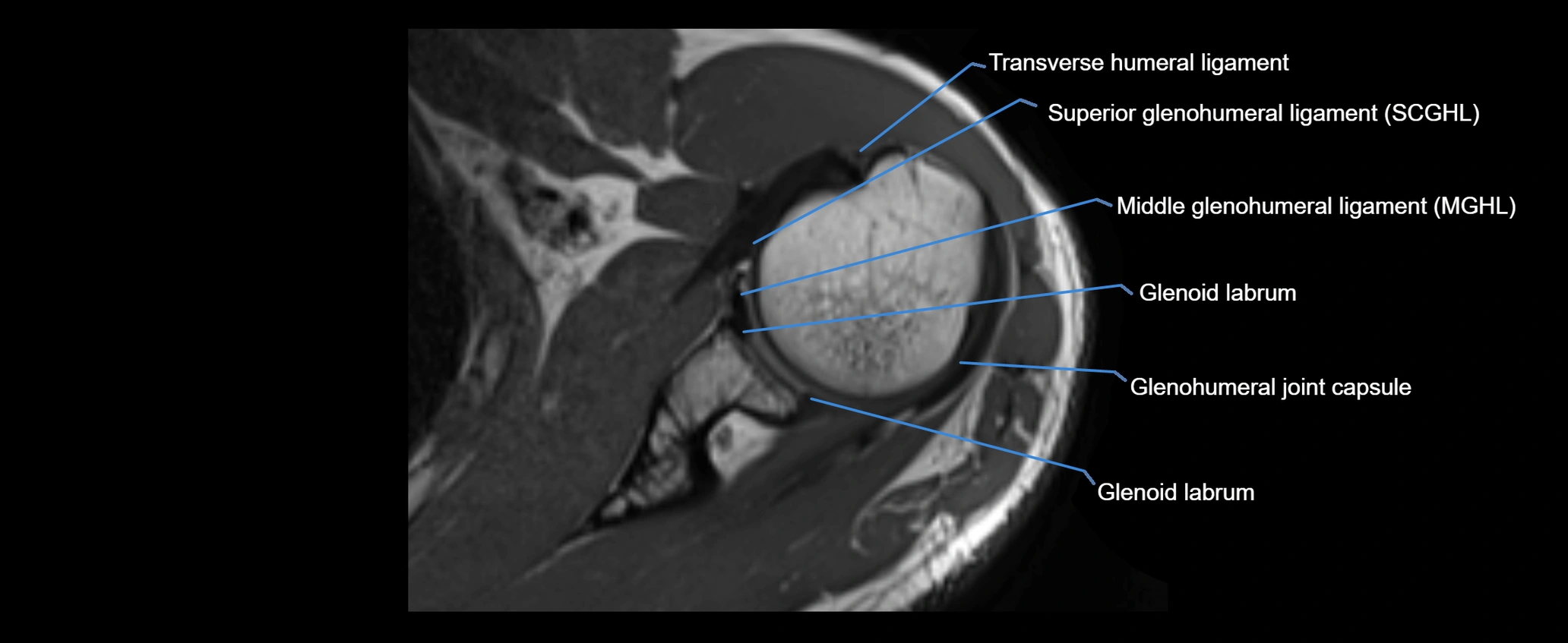 shoulder ligaments axial 3d 3t mri image-img-00005-00057.webp
